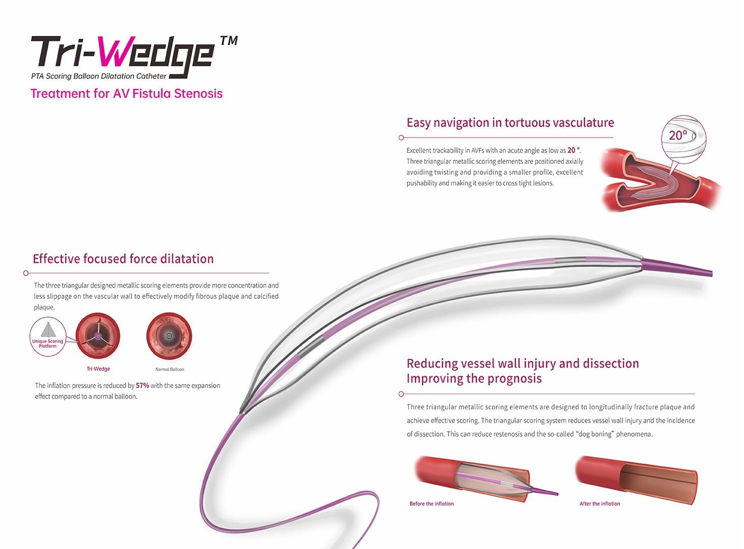 Infografia Tri-Wedge